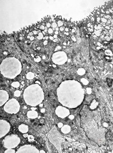 celiakia celiakia
